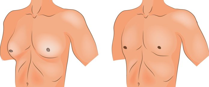 Gynecomastia Treatment